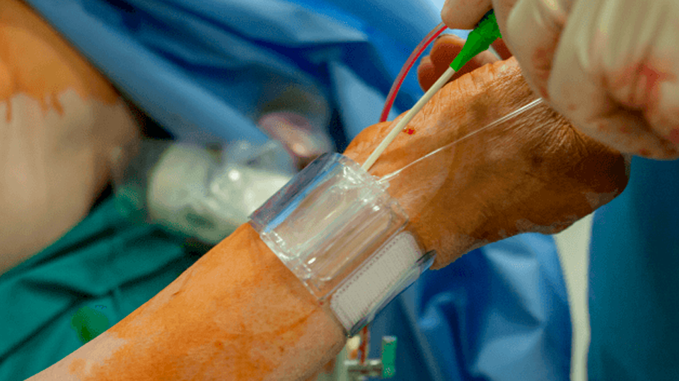 La ciencia confirma que el acceso radial izquierdo es la mejor opción | Grupo i2